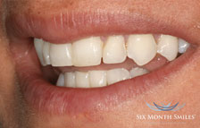 staight teeth in bucks